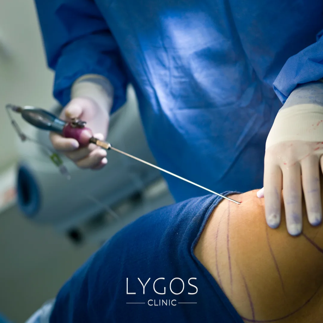 Liposuction Alternatives