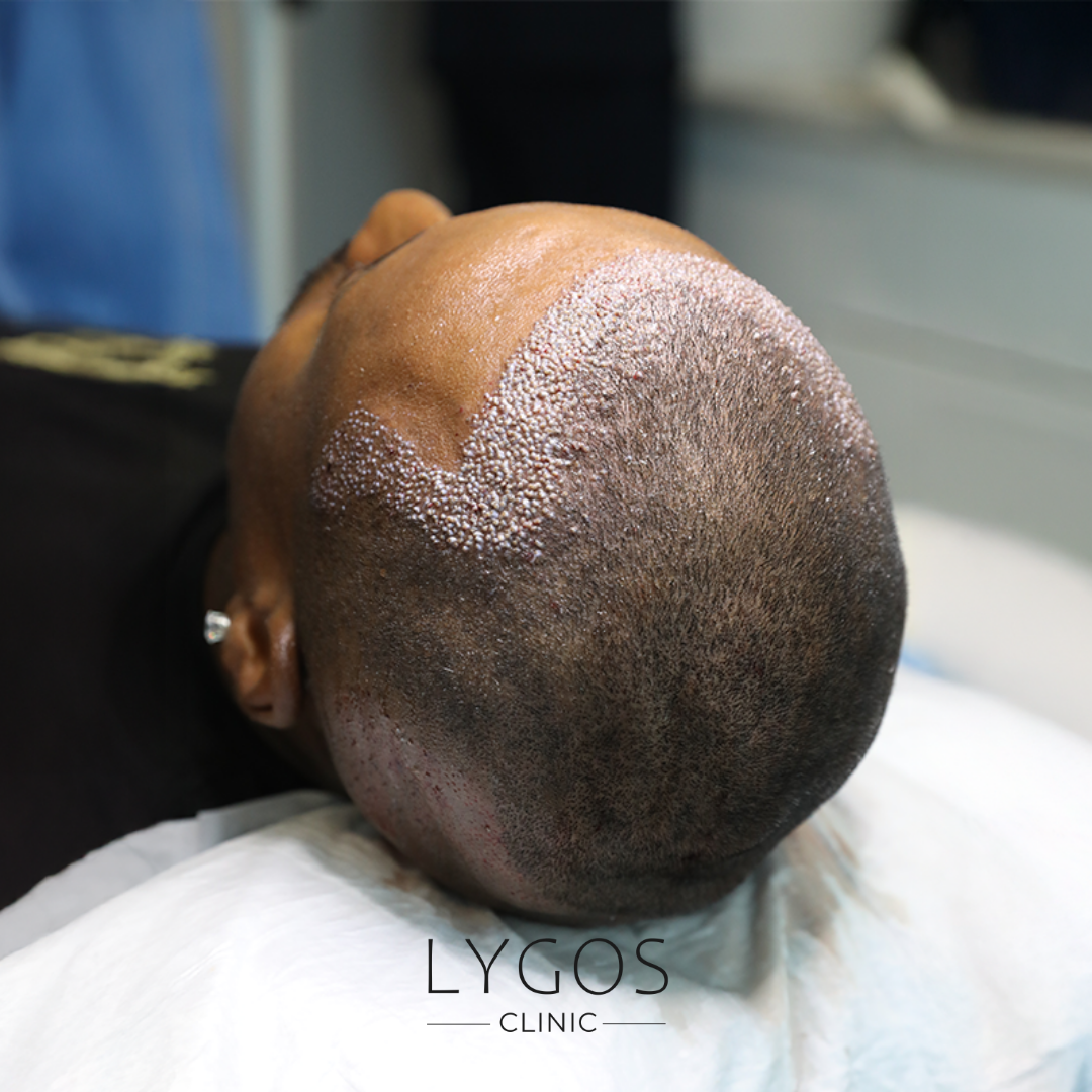 Expectations During the Hair Transplant Recovery Period 1 Expectations During the Hair Transplant Recovery Period