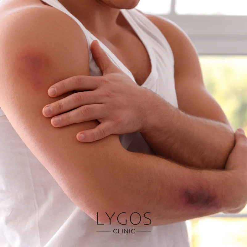 Why Bruising Occurs in the Body?