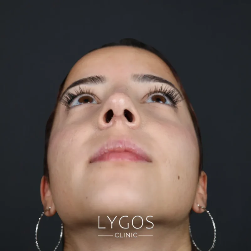 Differences Between Rhinoplasty and Alarplasty