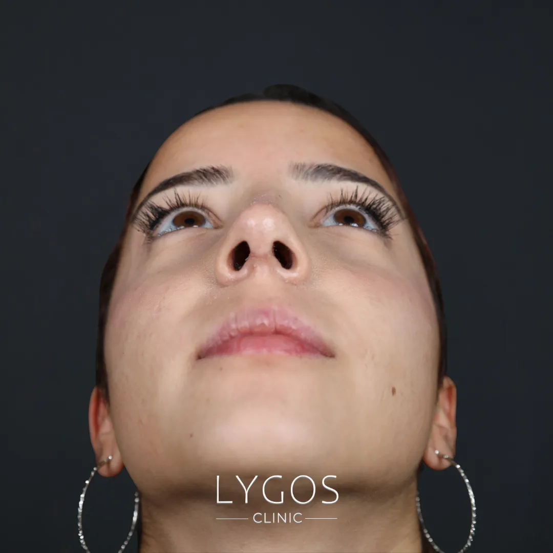 Rinoplasti ve Alarplasti Arasındaki Farklar 1 Differences Between Rhinoplasty and Alarplasty