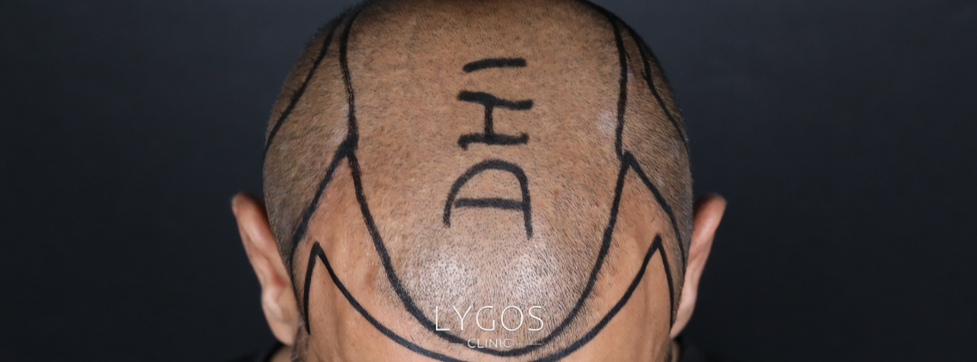 Türkiye ve İngiltere’de Saç Ekimi Fiyatları 2 Factors Affecting Hair Transplant Cost