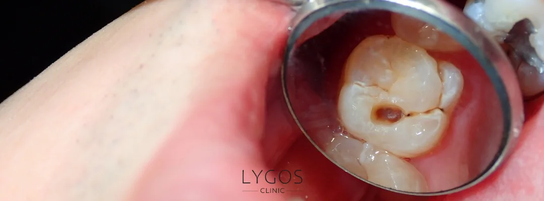 Causes of Tooth Loss in the Elderly