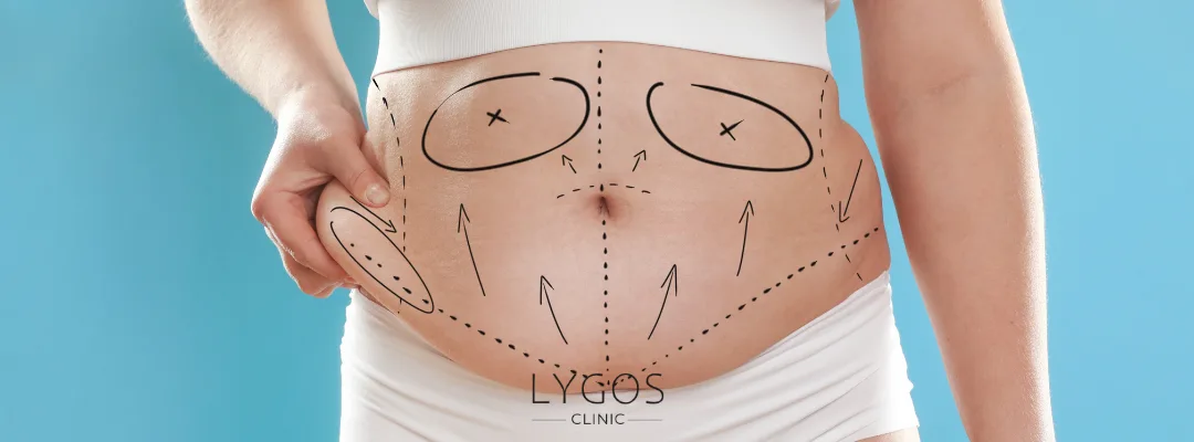 What is a Tummy Tuck Surgery?