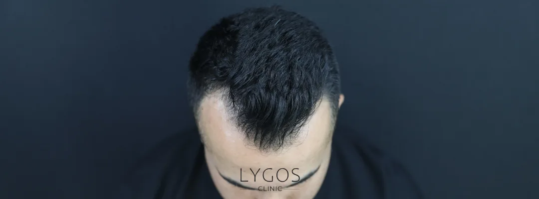 What is Temple Hair Loss?