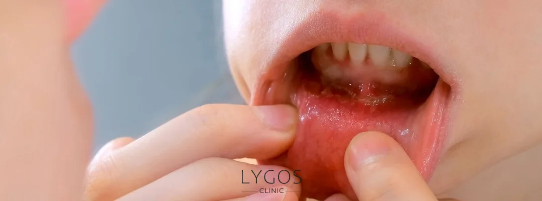 What is Oral Cancer?