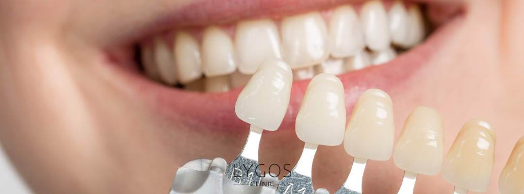 Common Mistakes in Dental Crowns and Veneers
