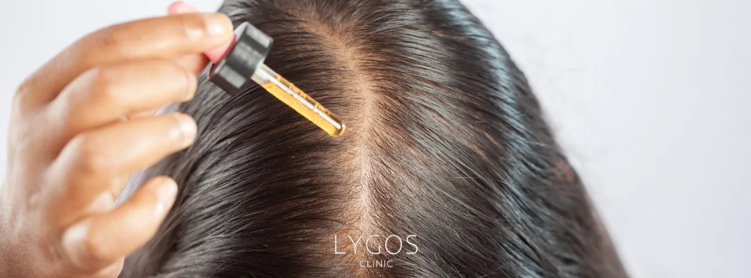 What Is Alopecia Areata