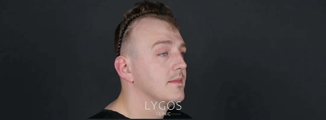 What is Temple Hair Loss?