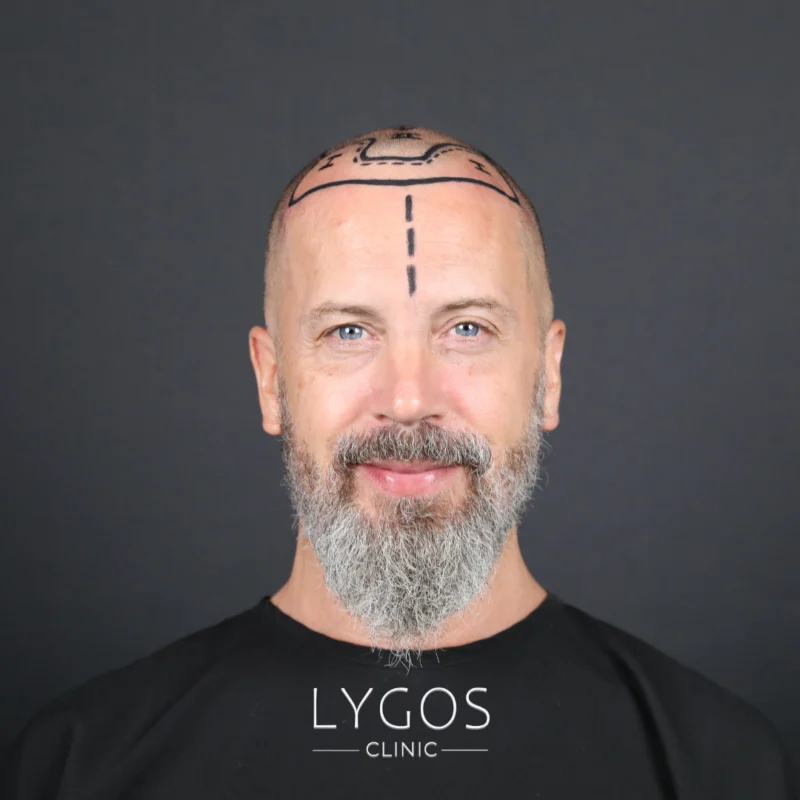 Hair Transplant Cost Turkey vs. UK