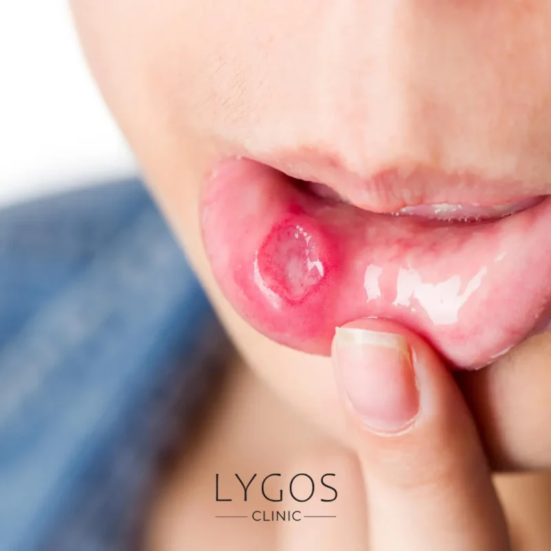 What is Oral Cancer