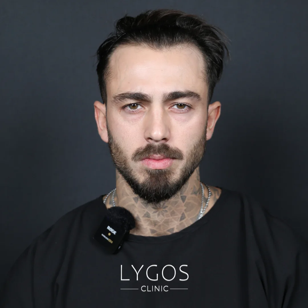 Temple Hair Loss