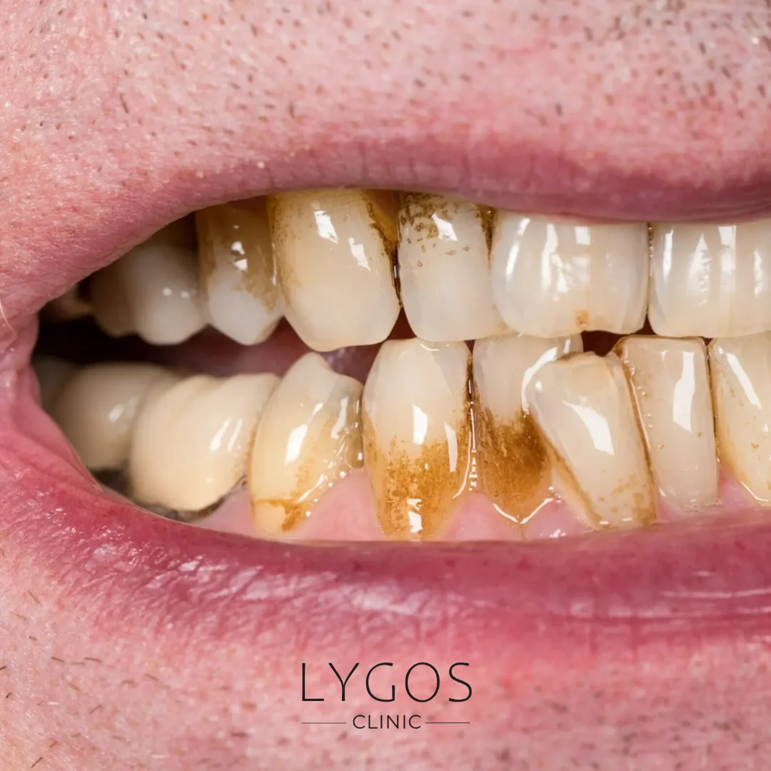 Dişlerdeki Kahverengi Lekeler | Nedenleri, Belirtileri ve Tedavi Yöntemleri 1 Brown Stains on Teeth