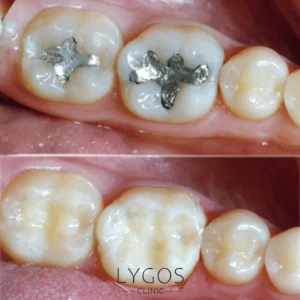 Hollywood Smile 36 Removal of Amalgam Fillings