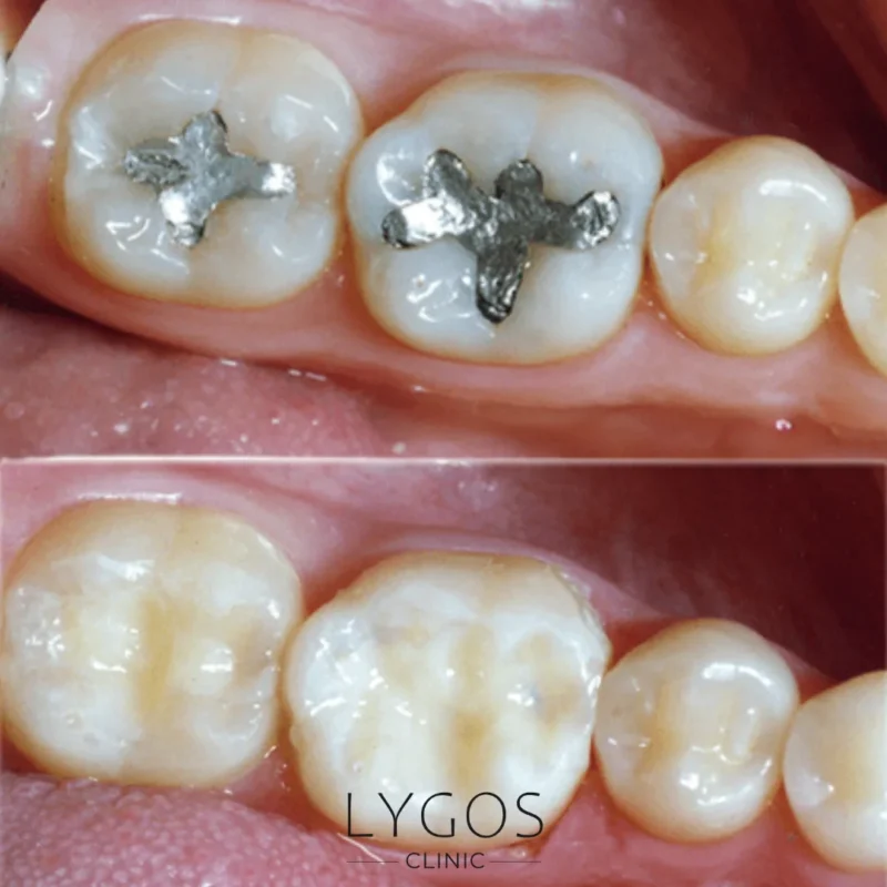 Removal of Amalgam Fillings