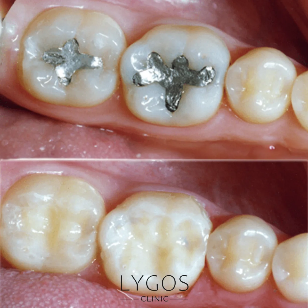 Removal of Amalgam Fillings