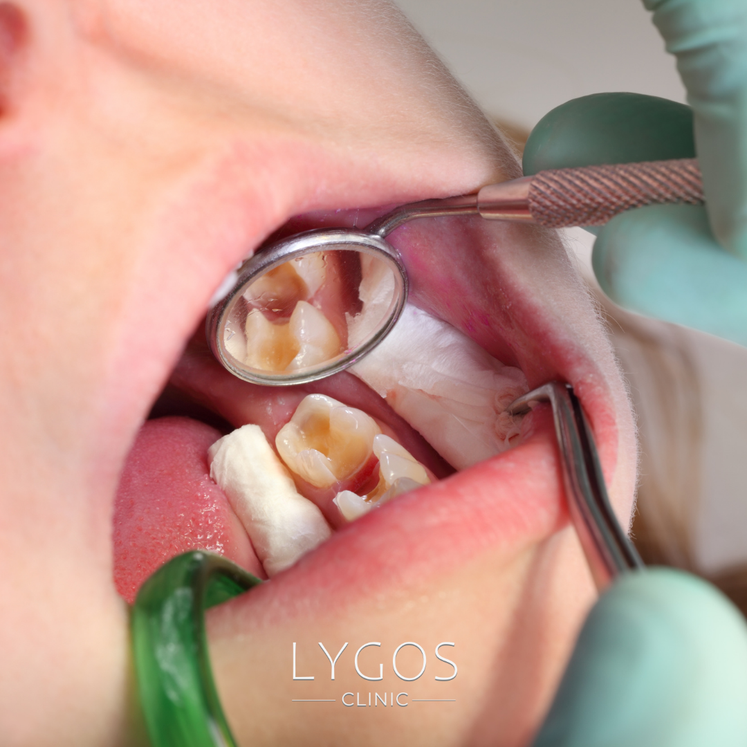 What to Do If a Dental Filling Falls Out?