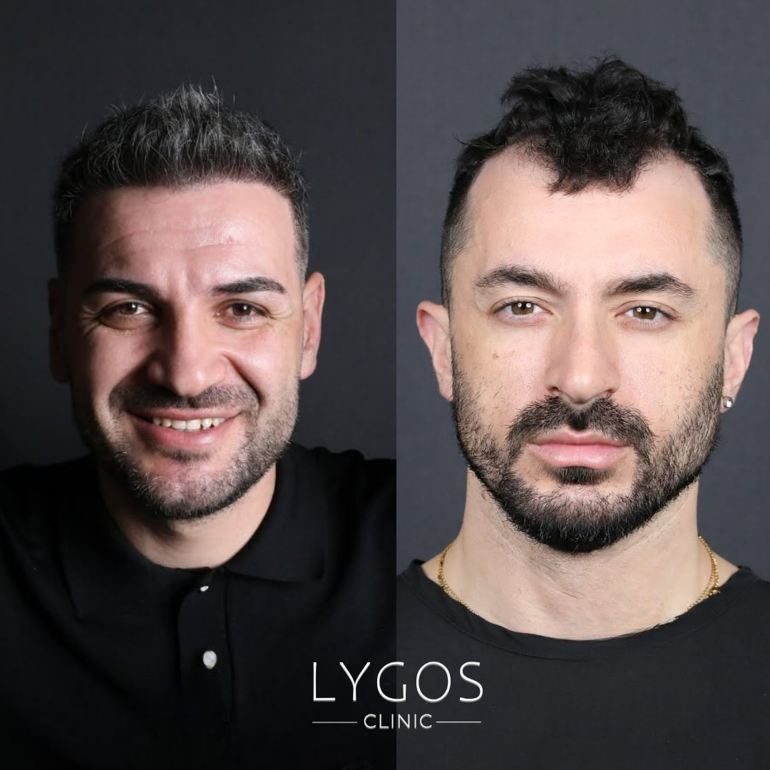 Olgun Saç Çizgisi mi, Geri Çekilmiş Saç Çizgisi mi? 1 Mature Hairline or Receding Hairline?