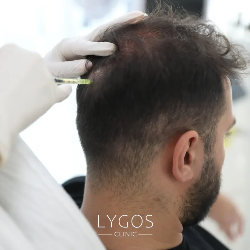 Stem Cell Hair Treatment