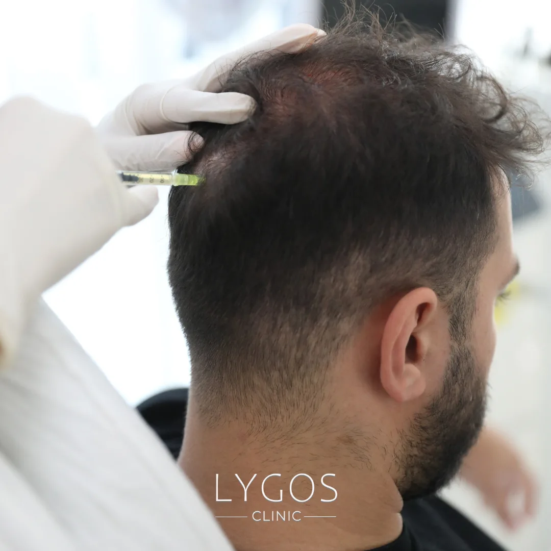Stem Cell Hair Treatment