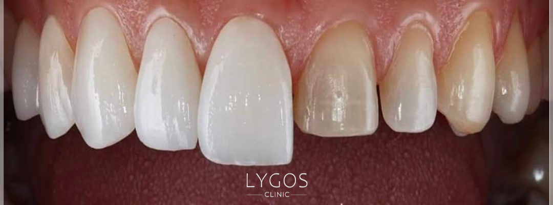 Zirconium Crown Prices in Turkey vs Germany 2 What is a Zirconium Crown?