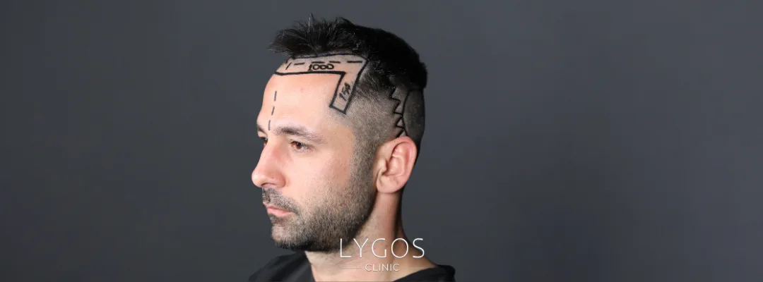What Is a Natural Hairline? | Why Does the Hairline Recede? 2 What Is a Natural Hairline?