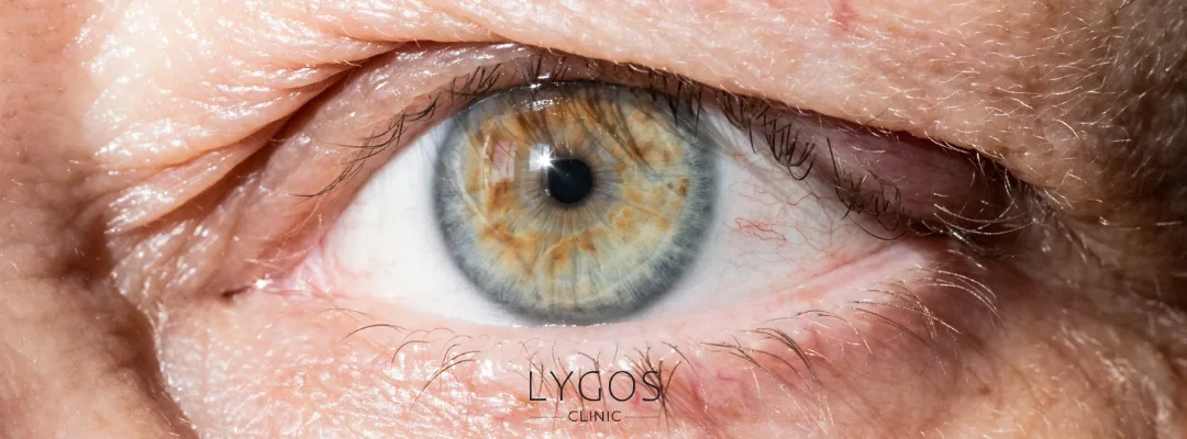Göz Kapağı Düşüklüğü Nedir? | Belirtileri ve Nedenleri 2 What is Eyelid Drooping