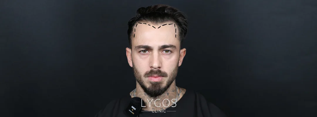 Hairline Types in Men