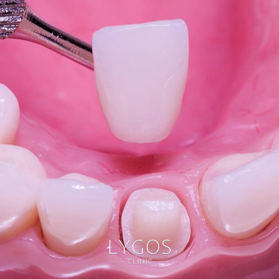 Zirconium Crown Prices in Turkey vs Germany 1 Zirconium Crown Prices in Turkey vs Germany