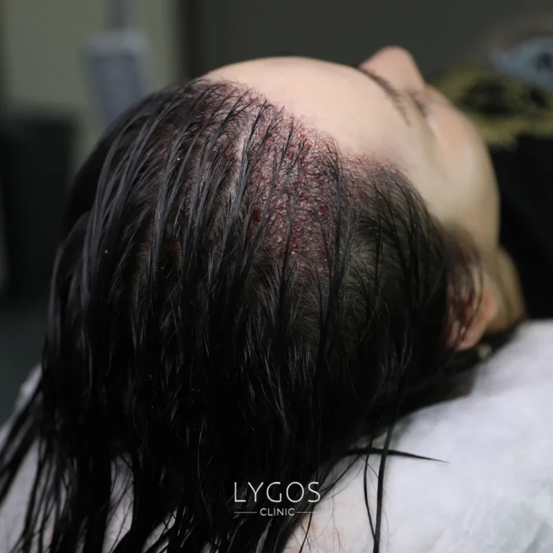 Shaven-Free Hair Transplant