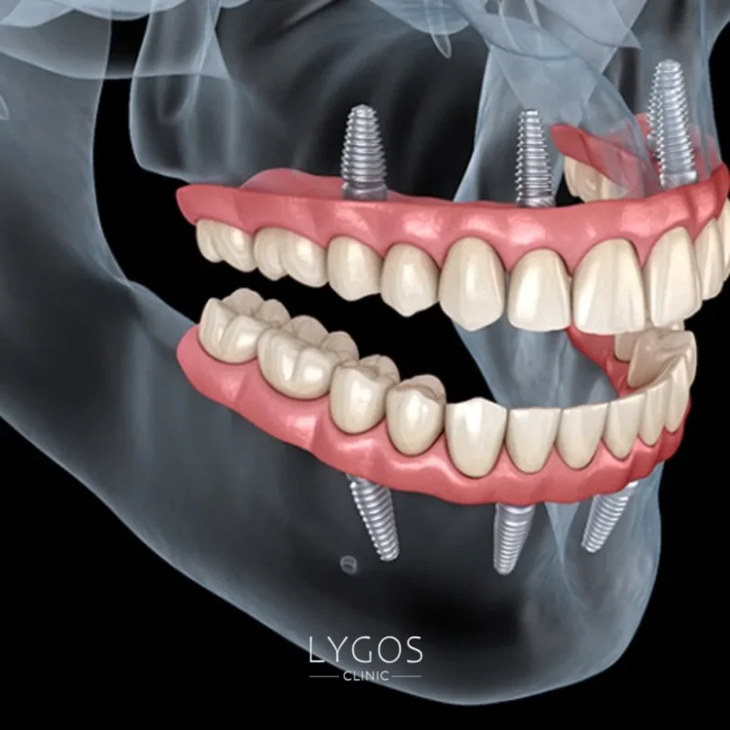 All-on-4 Dental Implants Turkey vs Canada