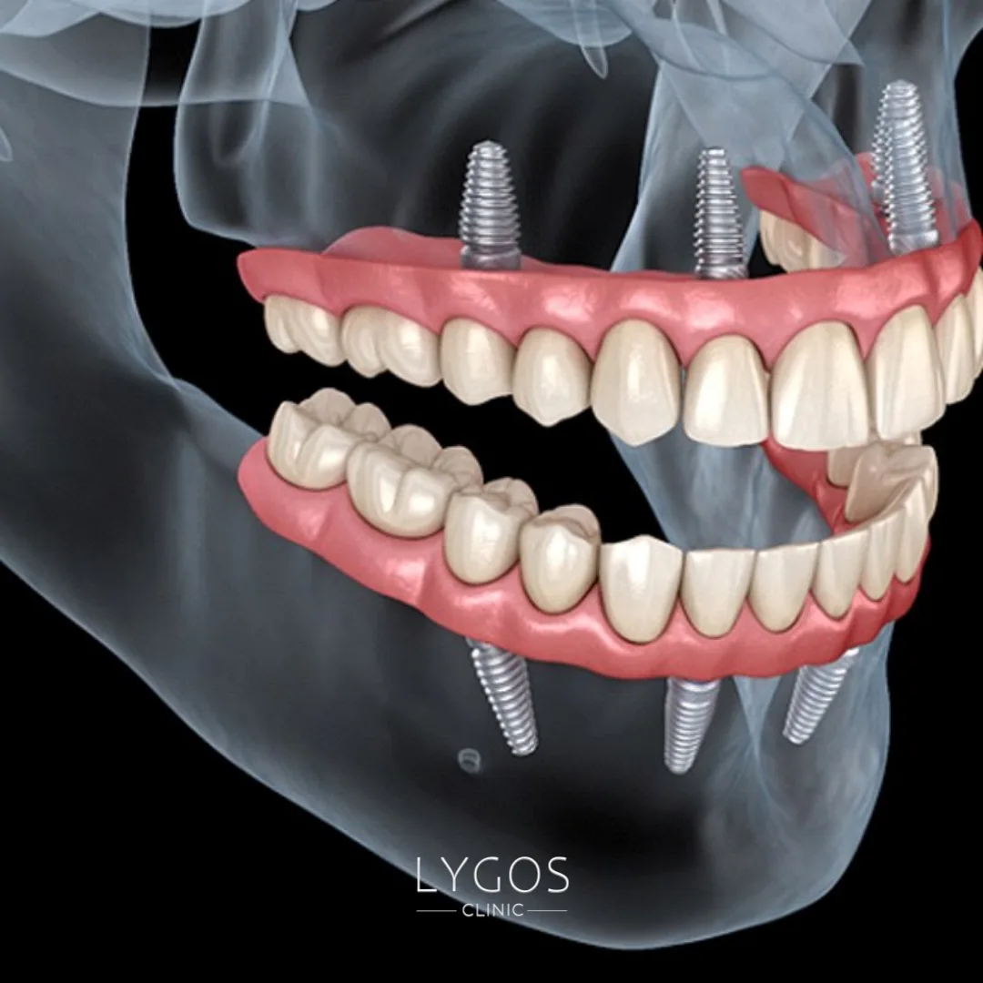 All-on-4 Dental Implants Turkey vs Canada