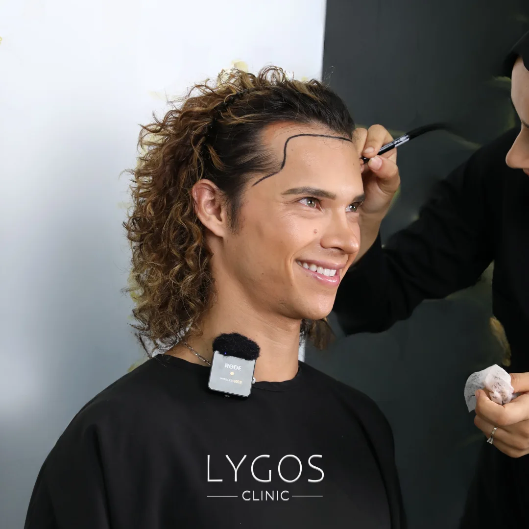 How Should Hairline Planning Be Done