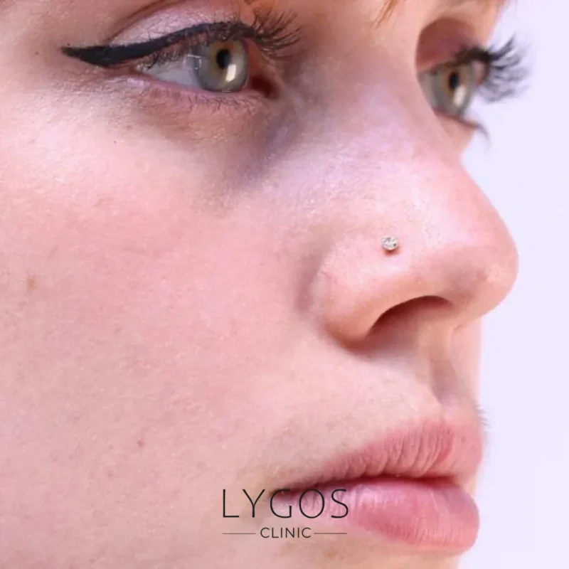 Post-Rhinoplasty Piercing Use