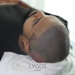 Gülüş Tasarımı 29 Post-Hair Transplant Rest Report