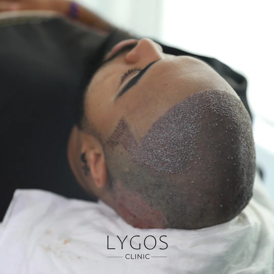 Saç Ekimi Sonrası İstirahat Raporu | Kaç Gün Dinlenmek Gerekir? 1 Post-Hair Transplant Rest Report