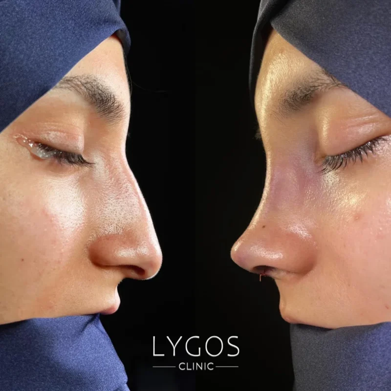 Nose Job in Turkey vs USA