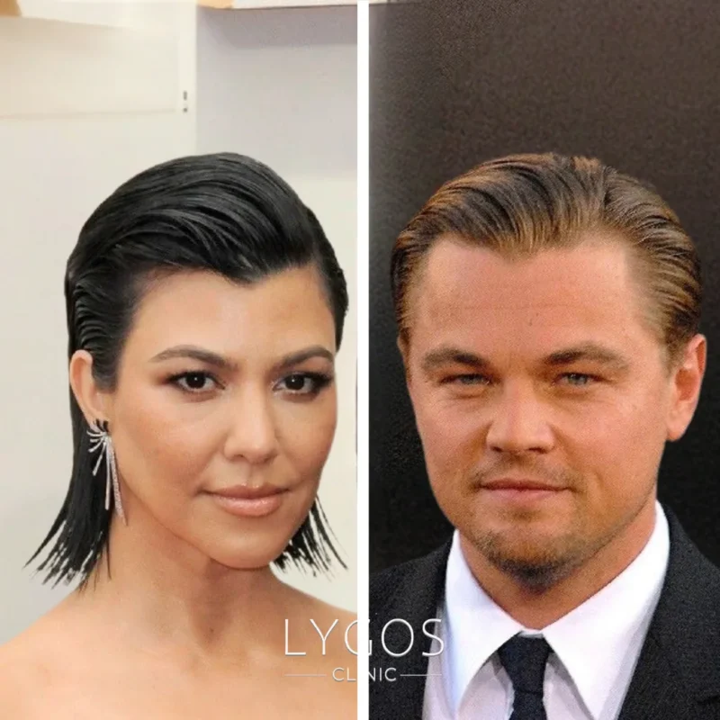 Different Hairline Types for Men and Women