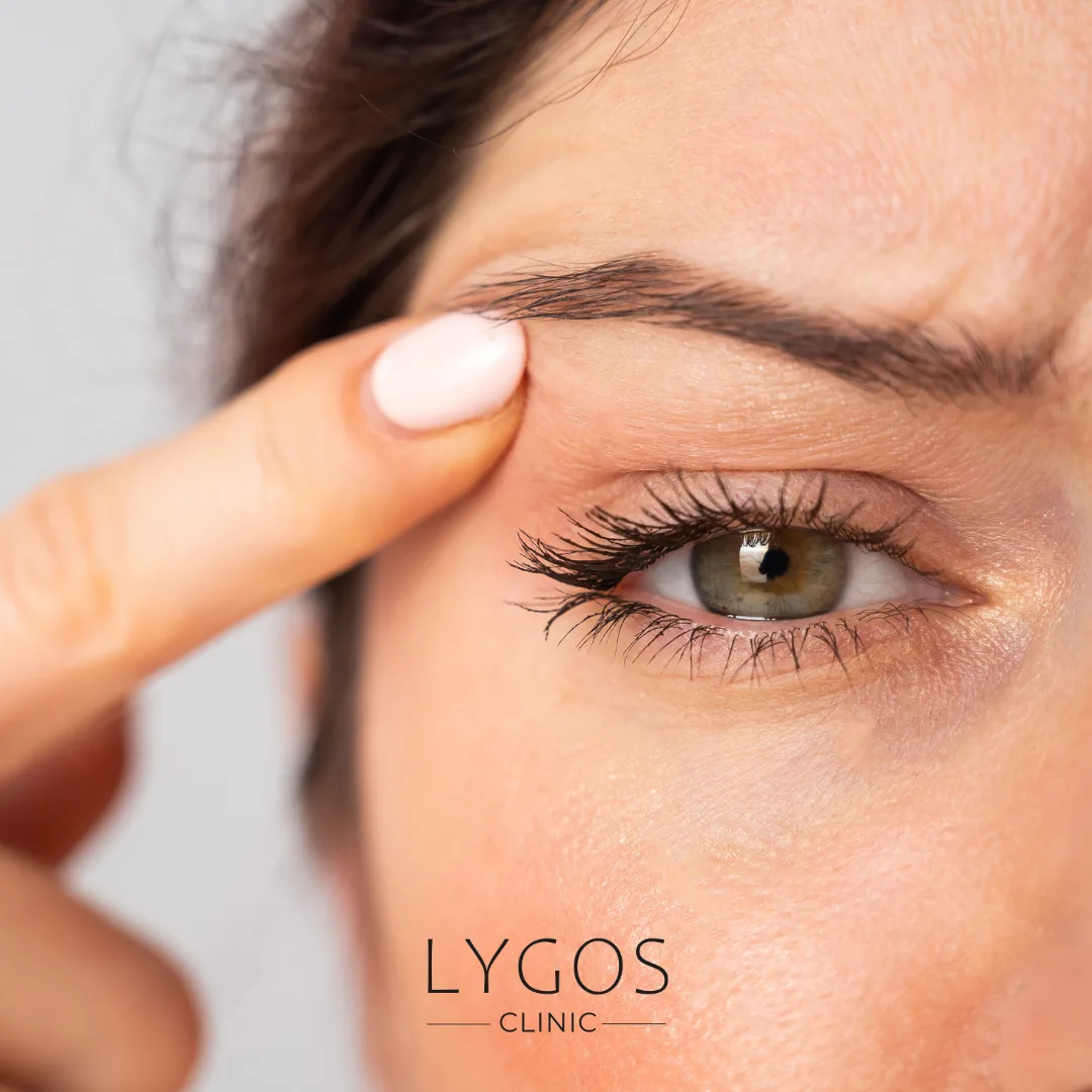 Göz Kapağı Düşüklüğü Nedir? | Belirtileri ve Nedenleri 1 What is Eyelid Drooping