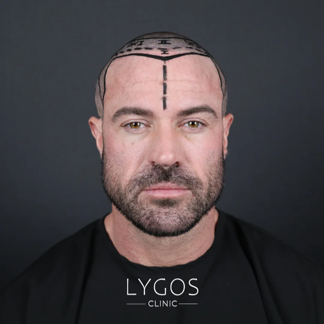 What Is a Natural Hairline? | Why Does the Hairline Recede? 1 What Is a Natural Hairline?