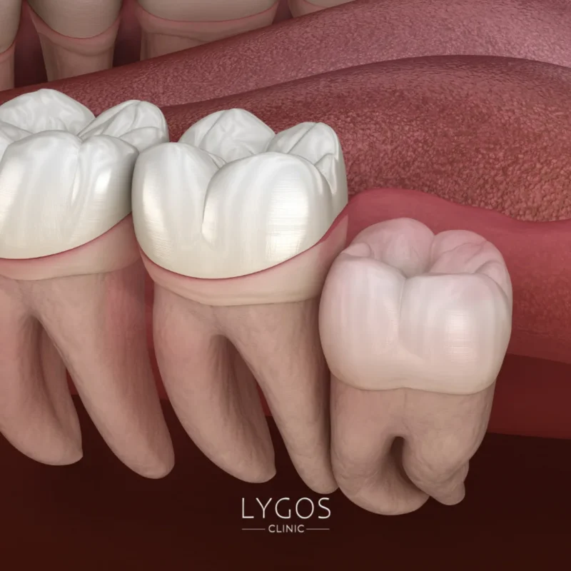 Why Do Not Wisdom Teeth Erupt Properly?
