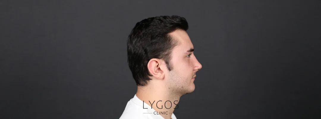 Why Choose Rhinoplasty in Bahçelievler?