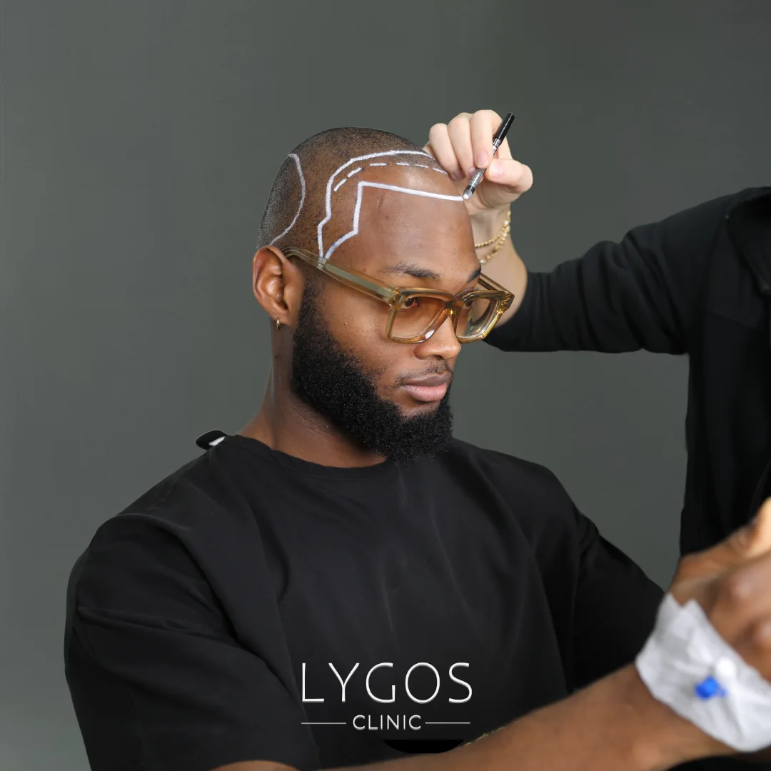 How is the Hairline Determined? 1 How is the Hairline Determined?