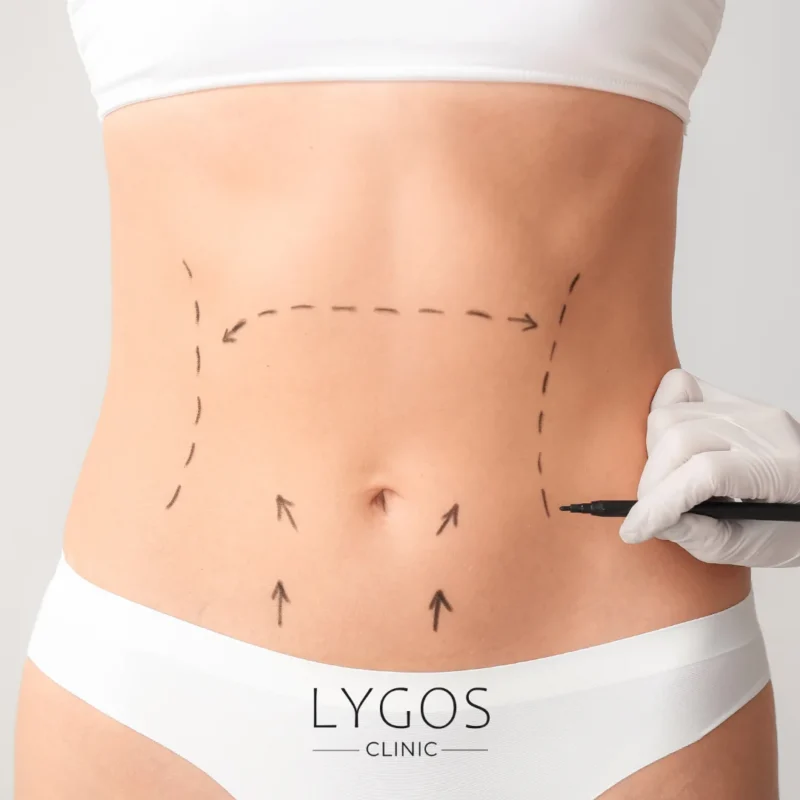 Returning to Daily Life After Abdominoplasty