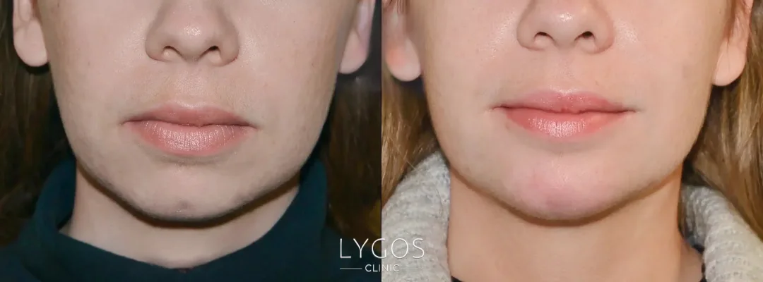 Who Is a Good Candidate for Jawline Enhancement?