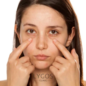 Smile Design 33 How to Get Rid of Dark Circles Under the Eyes?