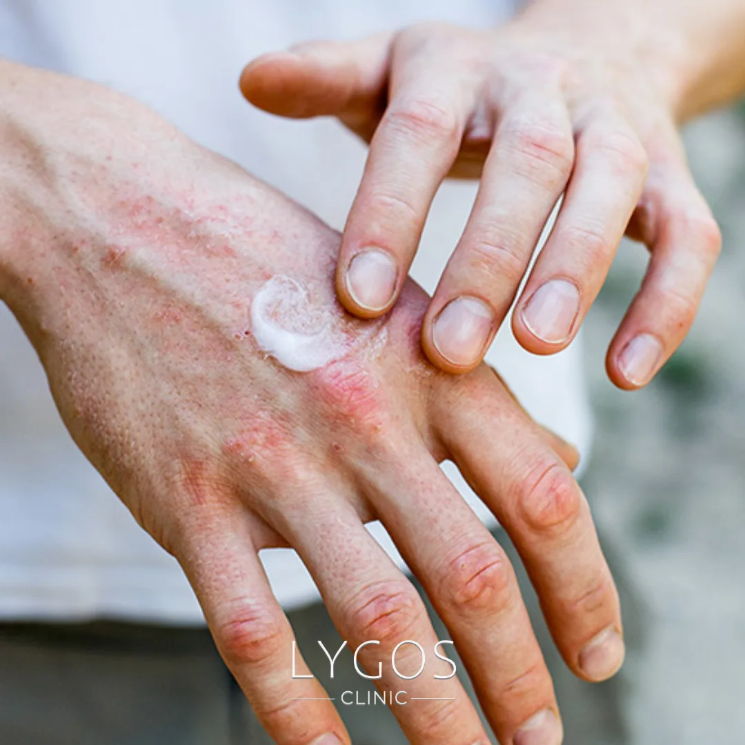 How to Get Rid of Dry Hands?