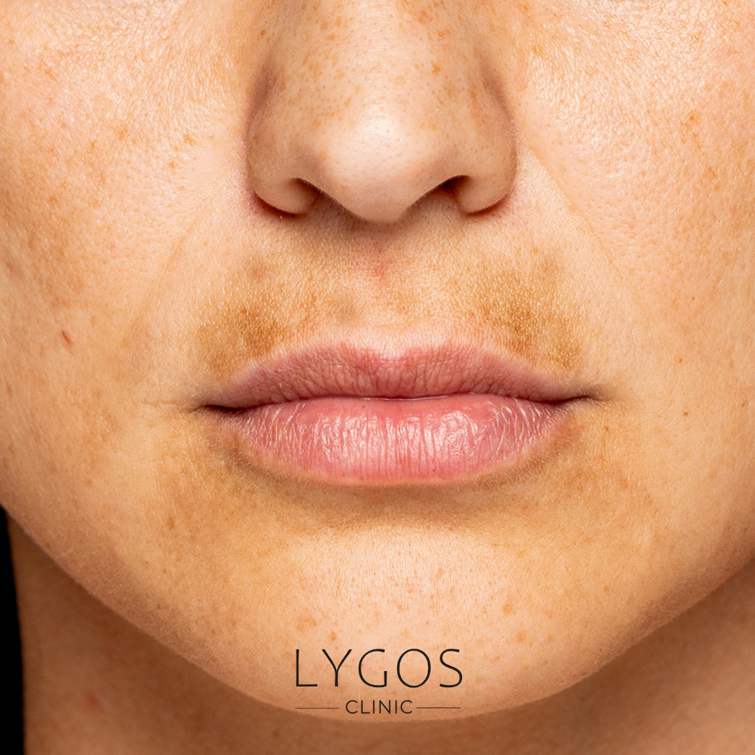 How to Get Rid of Upper Lip Darkening