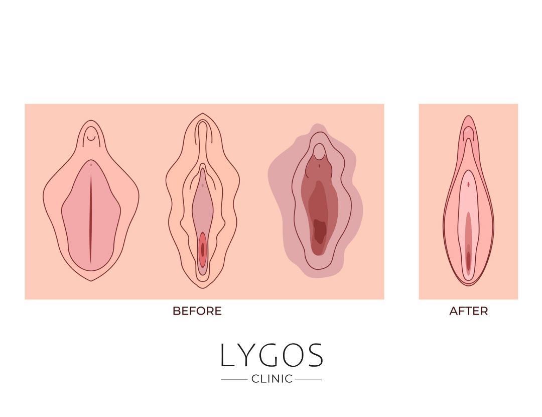 barbie genital aesthetic