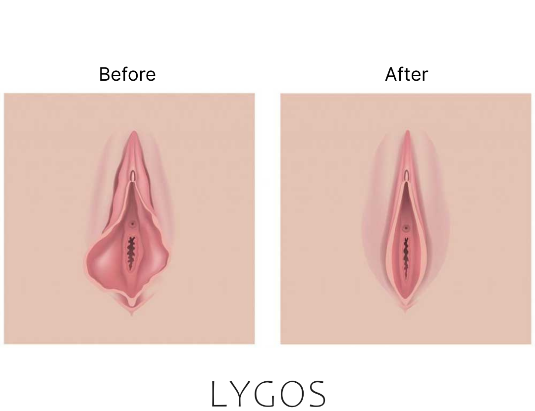 Genital (Vajina) Estetiği Nasıl Yapılır